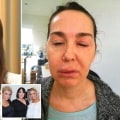 How long does botox toxicity last?