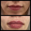 Is botox lip flip better than filler?