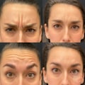 Are fillers better then botox?