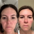 What causes botox to wear off early?