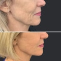 Is botox or fillers better for jowls?