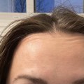 What happens when botox wears off on forehead?