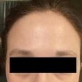 Is botox worth it for the forehead?