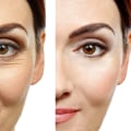 The Truth About Botox: Separating Fact from Fiction