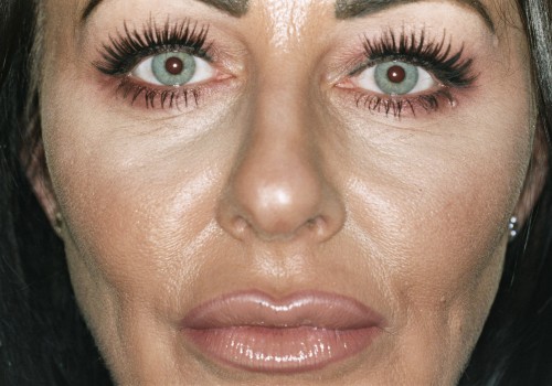 The Truth About Botox and Aging