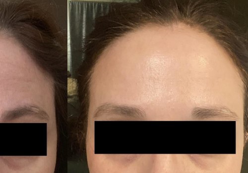 What happens when you stop getting botox in your forehead?