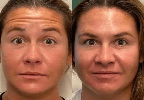 What happens when you get botox for a long time?