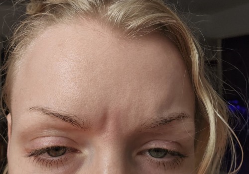 How to tell if botox has worn off?