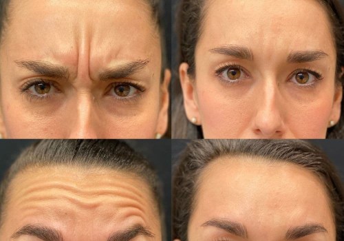 What is healthier botox or filler?