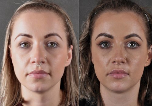 The Truth About Botox Longevity in the Forehead