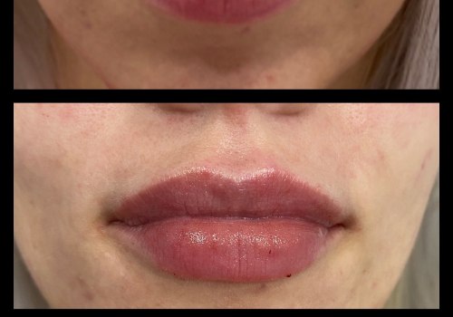 Is botox lip flip better than filler?