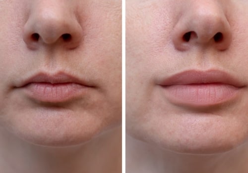 Is lip filler cheaper than botox?