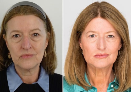 Do you age faster after stopping botox?