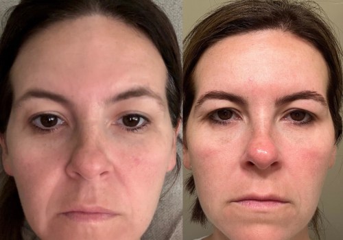 What causes botox to wear off early?