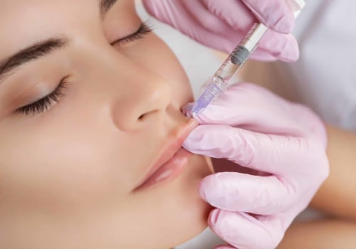 What is better, botox or fillers for lips?