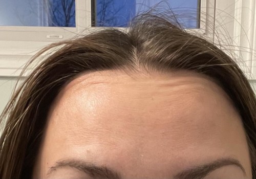 What happens when botox wears off on forehead?