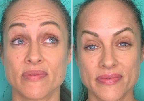 Why does botox have a bad reputation?