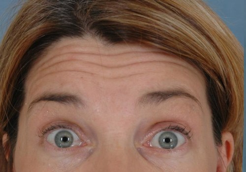 What affects botox duration?