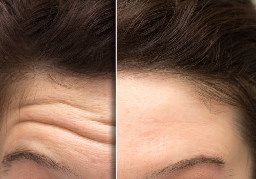 The Science Behind Botox: How Long Do Its Effects Really Last?